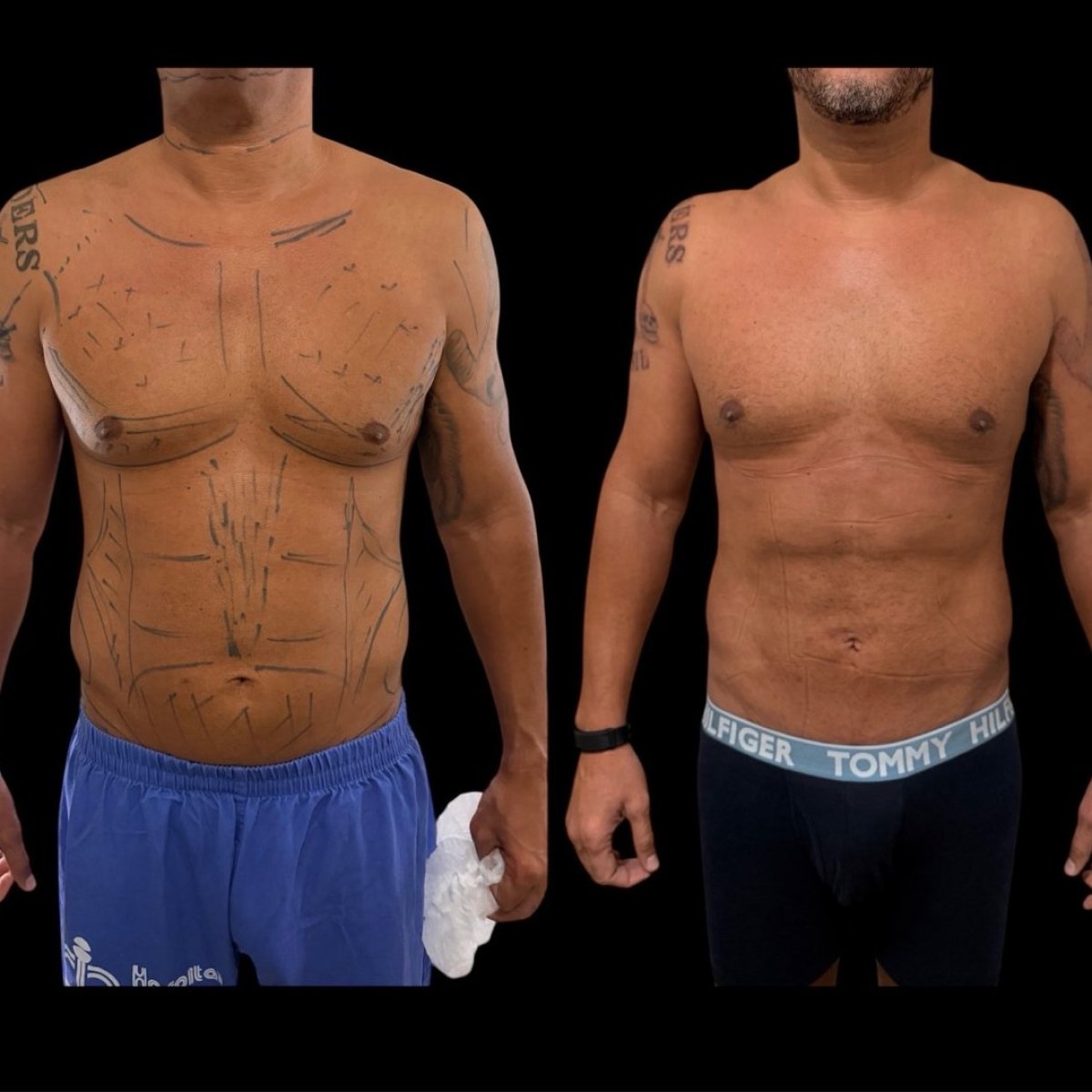 Resultados de liposucción 360 antes y después en Dr. Michel Salameh - Plastic And Aesthetic Surgery