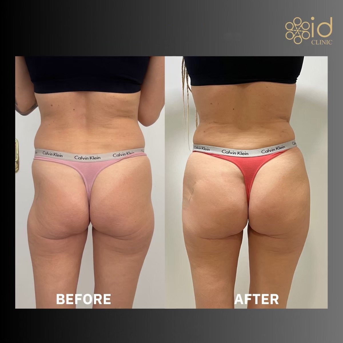 نتائج قبل وبعد عملية Brazilian Butt Lift في ID Clinic Bangkok، تحسين شكل الأرداف