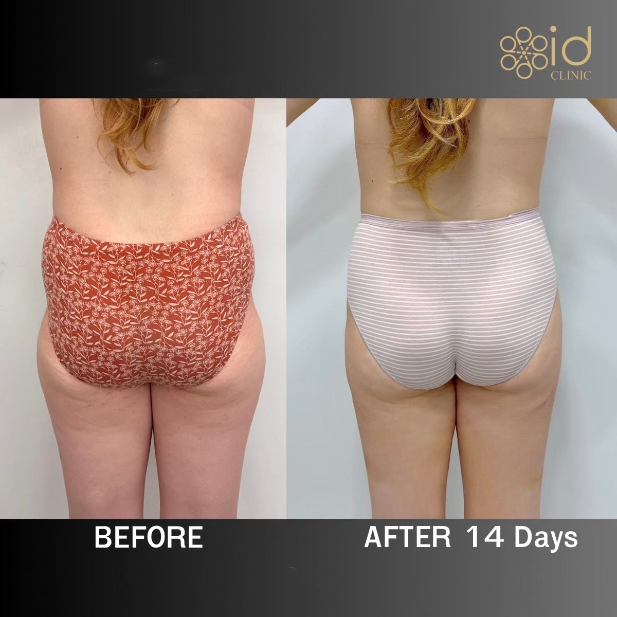 نتائج قبل وبعد عملية Brazilian Butt Lift في ID Clinic Bangkok وتحسن واضح في الشكل