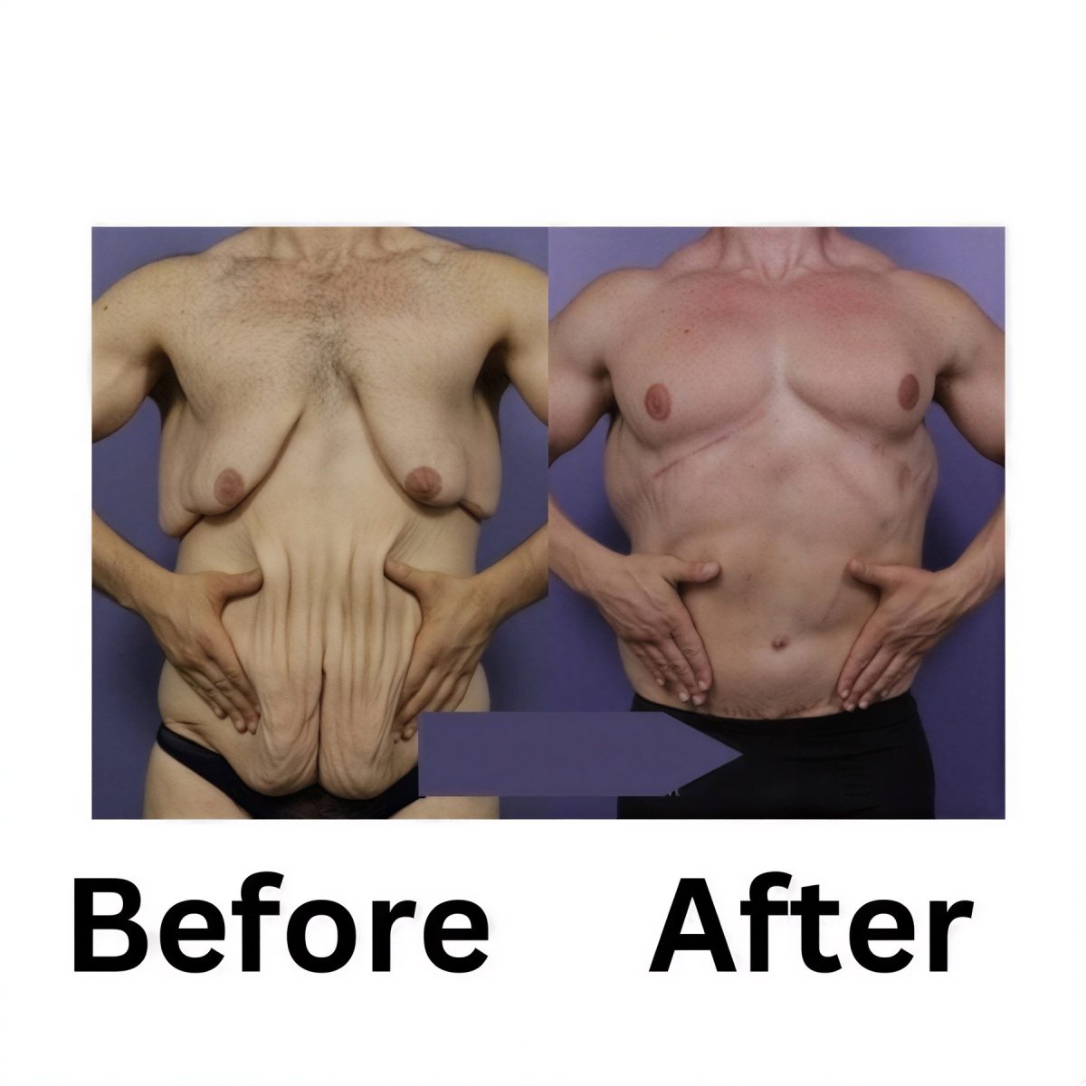 نتائج قبل وبعد جراحة التثدي في ID Clinic Bangkok، تحسين شكل صدر الرجل