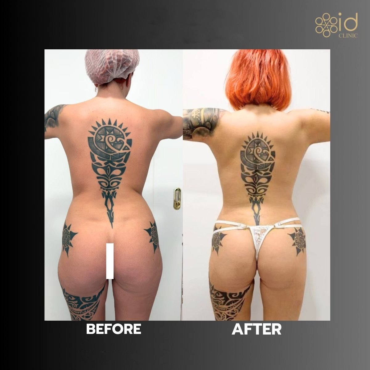 Resultados de liposucción antes y después en ID Clinic Bangkok, mejora visible del contorno corporal