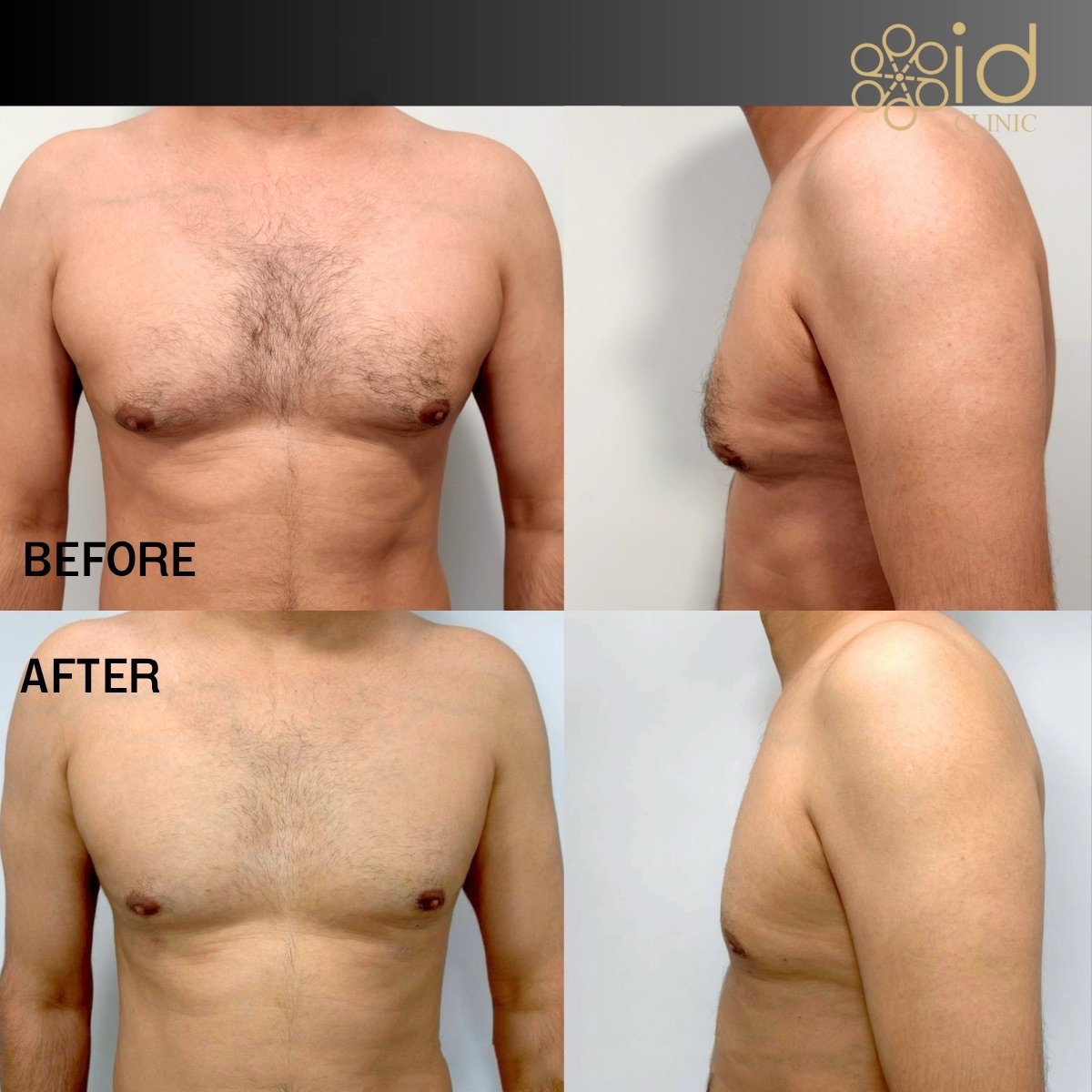 نتائج شفط الدهون فايزر قبل وبعد في ID Clinic Bangkok، تحسين شكل صدر الرجل