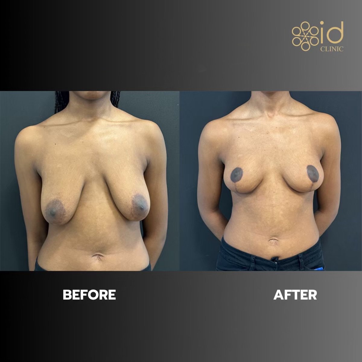 نتائج شد الثدي قبل وبعد في ID Clinic Bangkok، تحسين شكل وتناسق الثدي