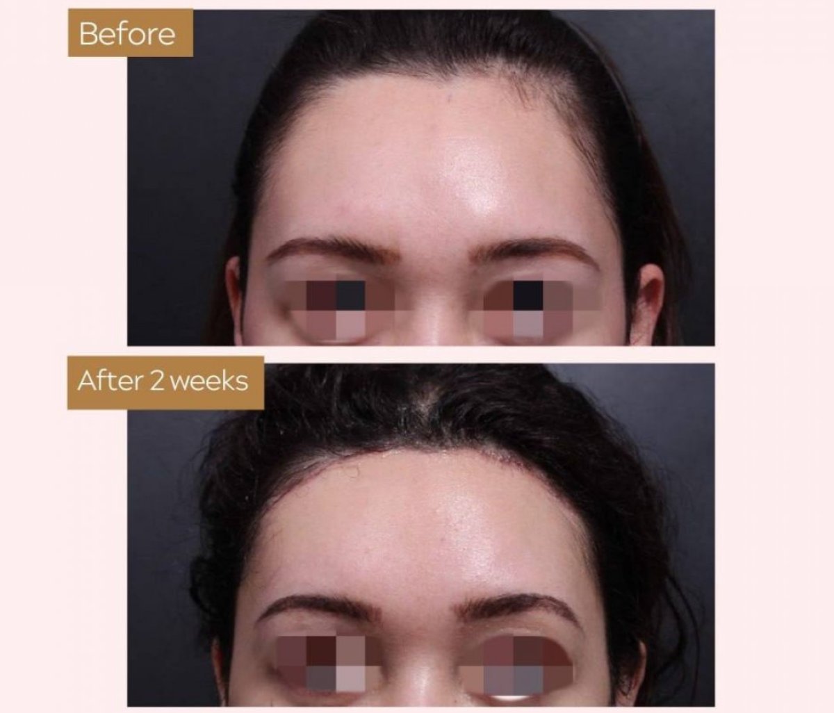 Forehead lift before and after results at VG Plastic Surgery, visible brow elevation improvement