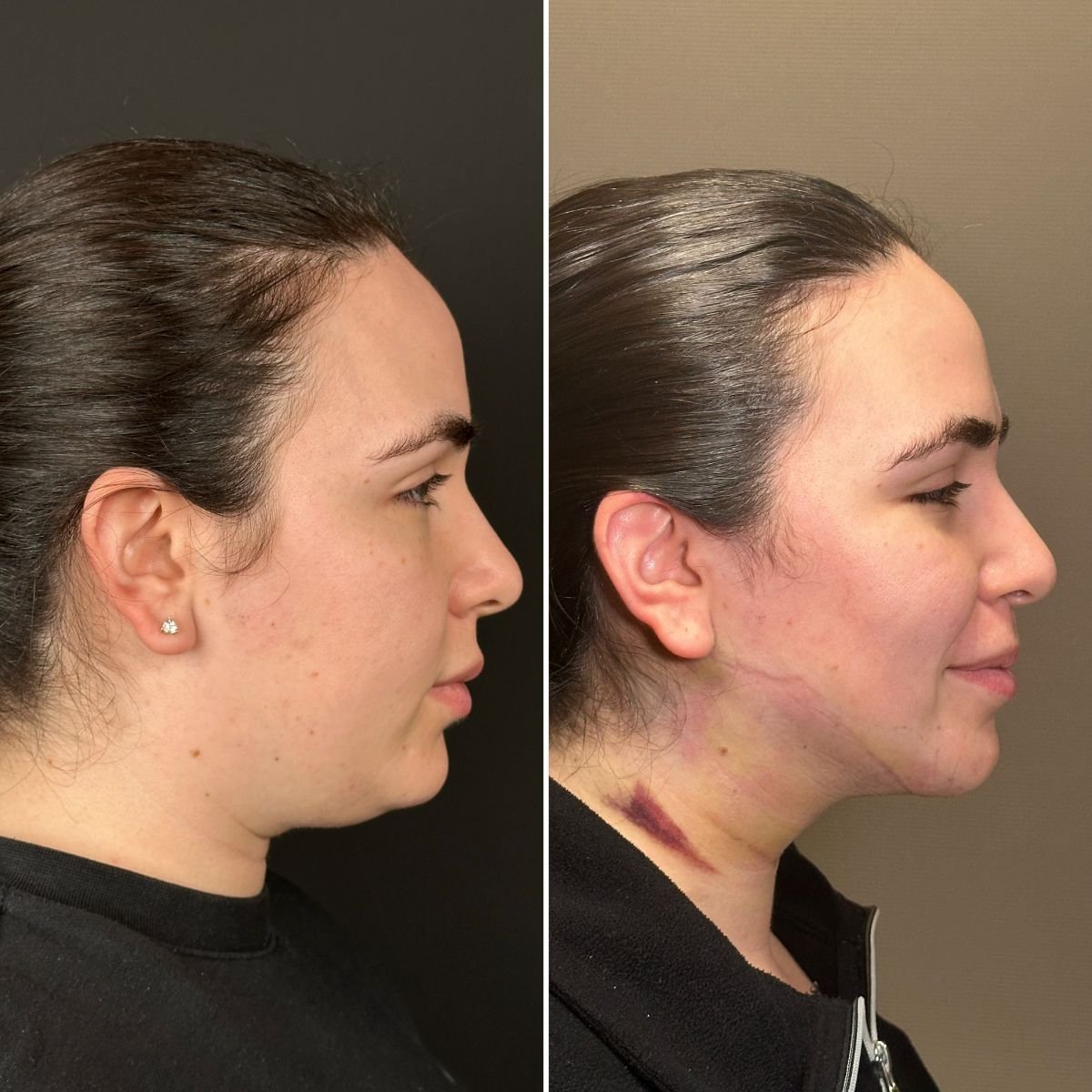 Resultados antes y después de lifting endoscópico facial en Dr. Safa Manav Clinic, contorno mejorado
