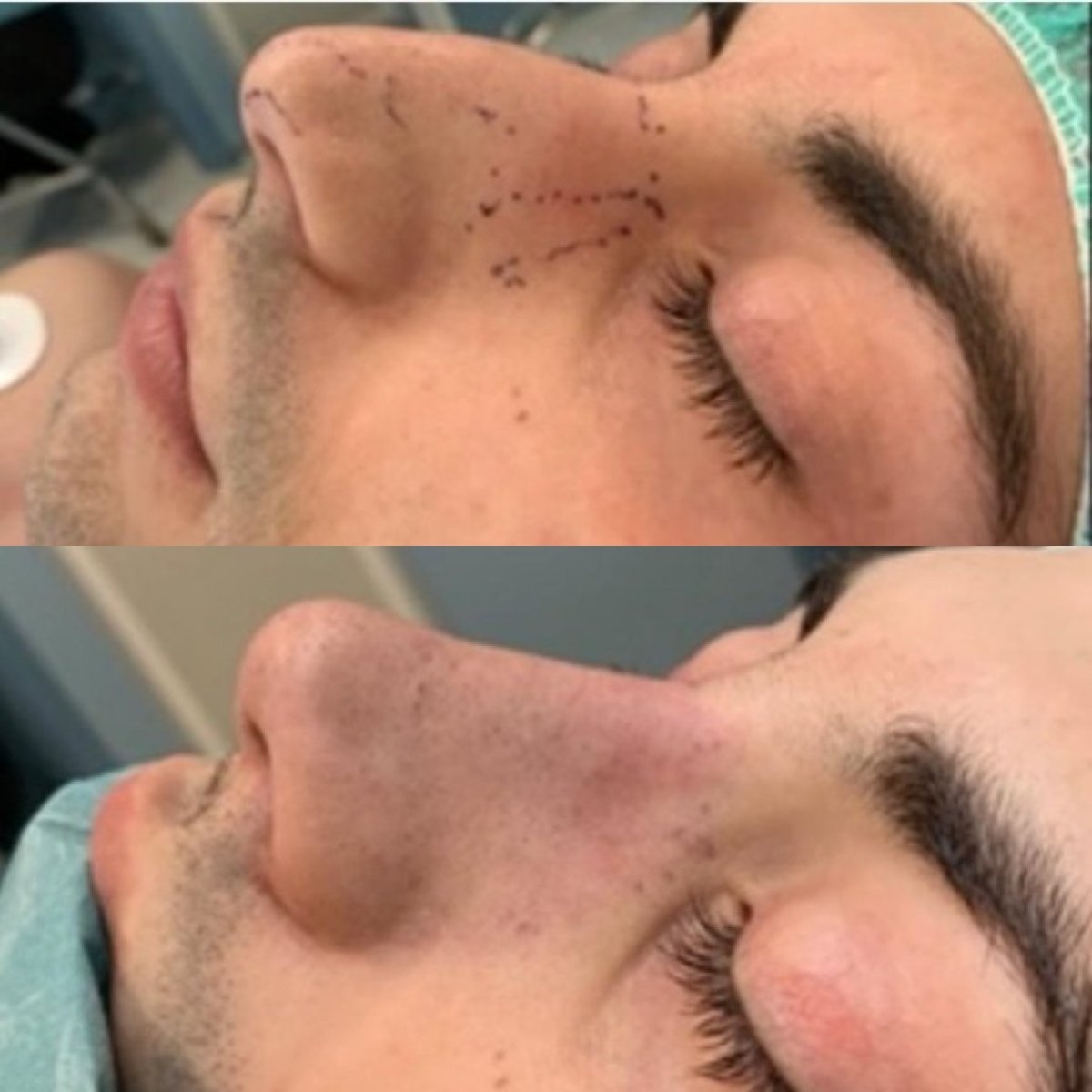 Resultado antes y después de rinoplastia ultrasónica en Dr. Fabiano Arruda – remodelación nasal