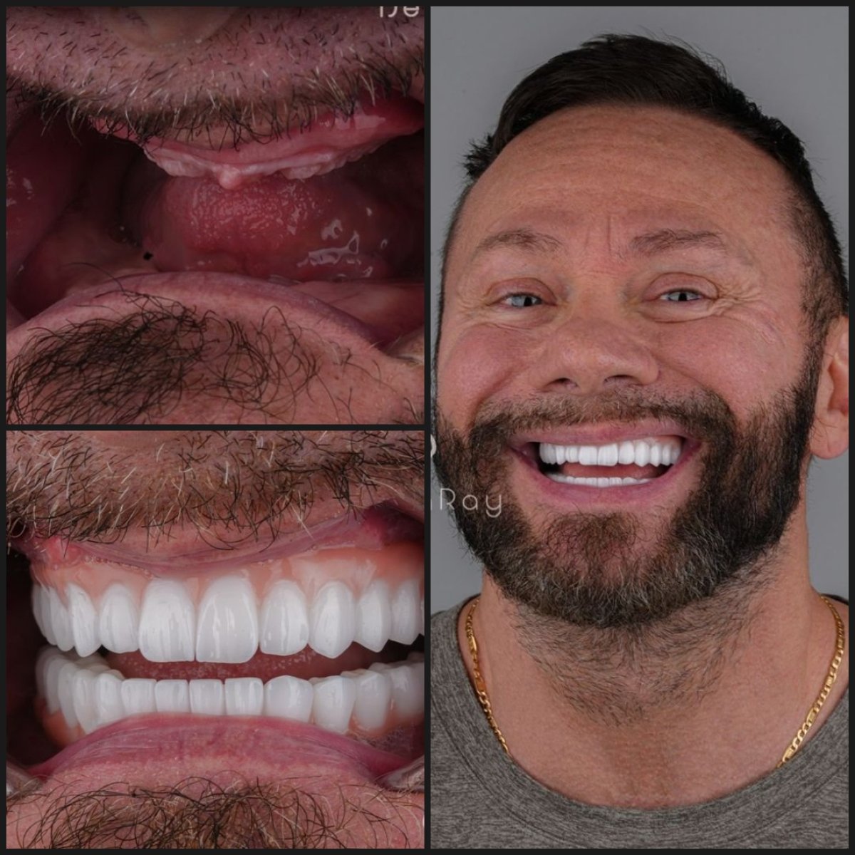 نتائج زراعة الأسنان قبل وبعد في عيادة Dentaray – استعادة ابتسامة كاملة لمريض ذكر