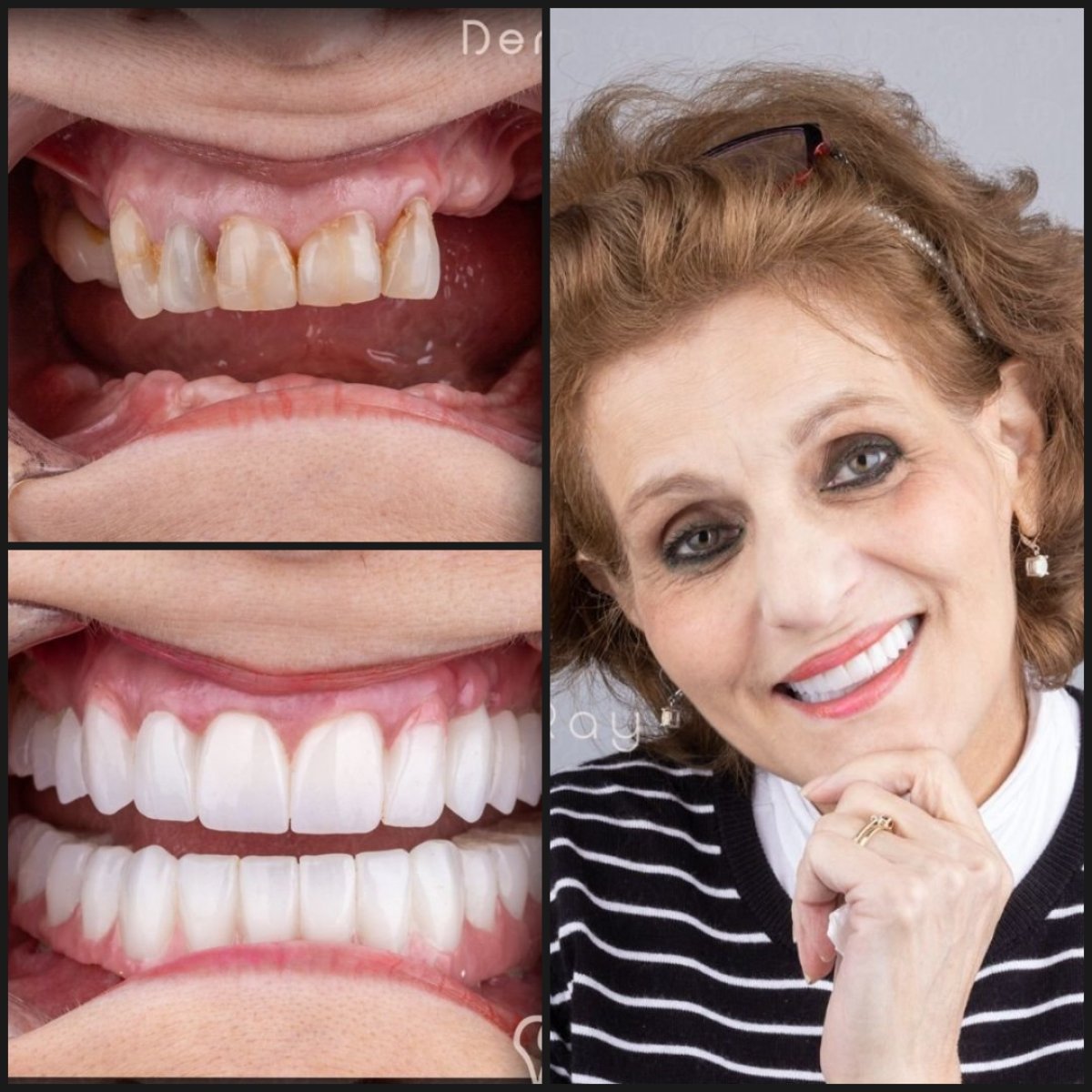 نتائج قبل وبعد زراعة الأسنان All-on-4 في عيادة Dentaray، استعادة الابتسامة
