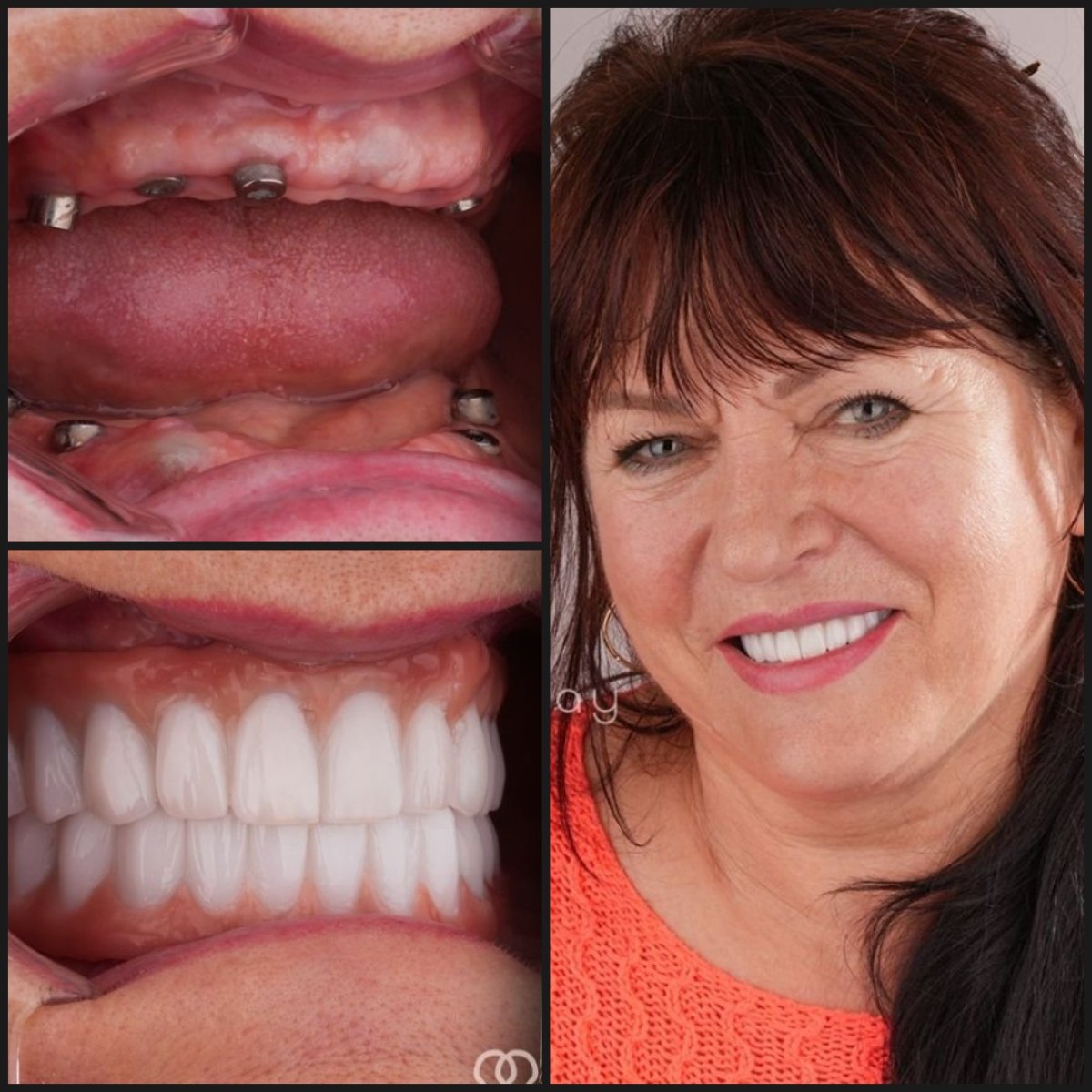 نتائج زراعة الأسنان All-on-4 قبل وبعد في عيادة Dentaray، استعادة الابتسامة الكاملة
