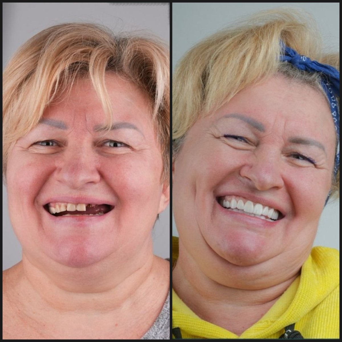 نتيجة قبل وبعد زراعة الأسنان All-on-4 في عيادة Dentaray، استعادة الابتسامة الكاملة