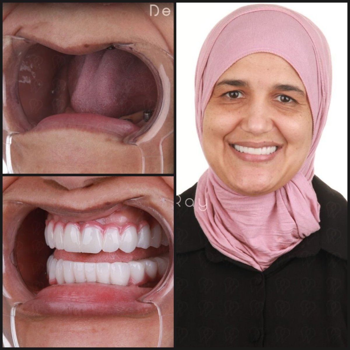 نتائج زراعة الأسنان All-on-4 قبل وبعد في عيادة Dentaray، استعادة الابتسامة الكاملة