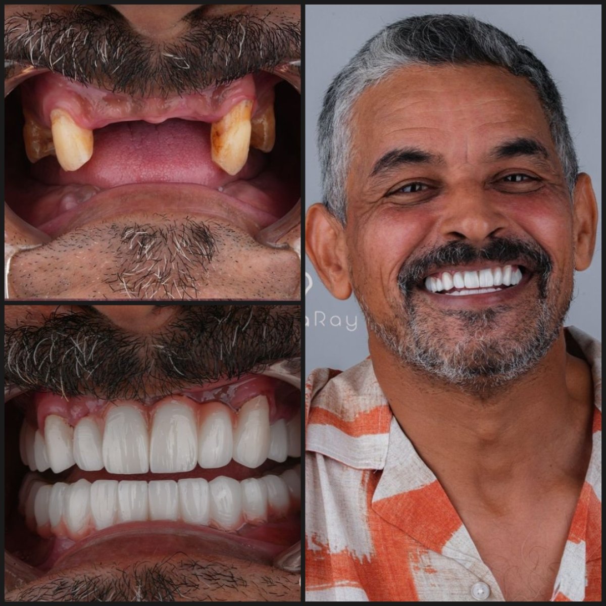 نتائج قبل وبعد زراعة الأسنان مع التاج في عيادة Dentaray، استعادة الابتسامة