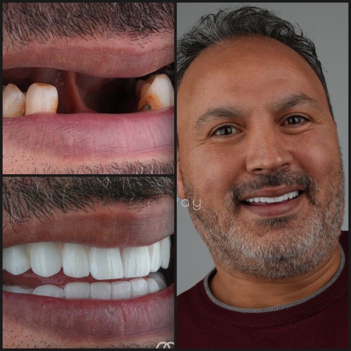 نتائج قبل وبعد زراعة الأسنان All-on-6 في Dentaray Clinic، استعادة الابتسامة الكاملة