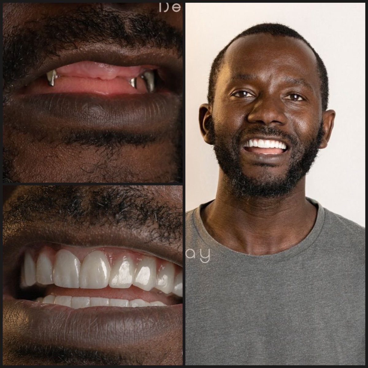 نتائج قبل وبعد زراعة الأسنان All-on-6 في عيادة Dentaray، ابتسامة طبيعية مستعادة