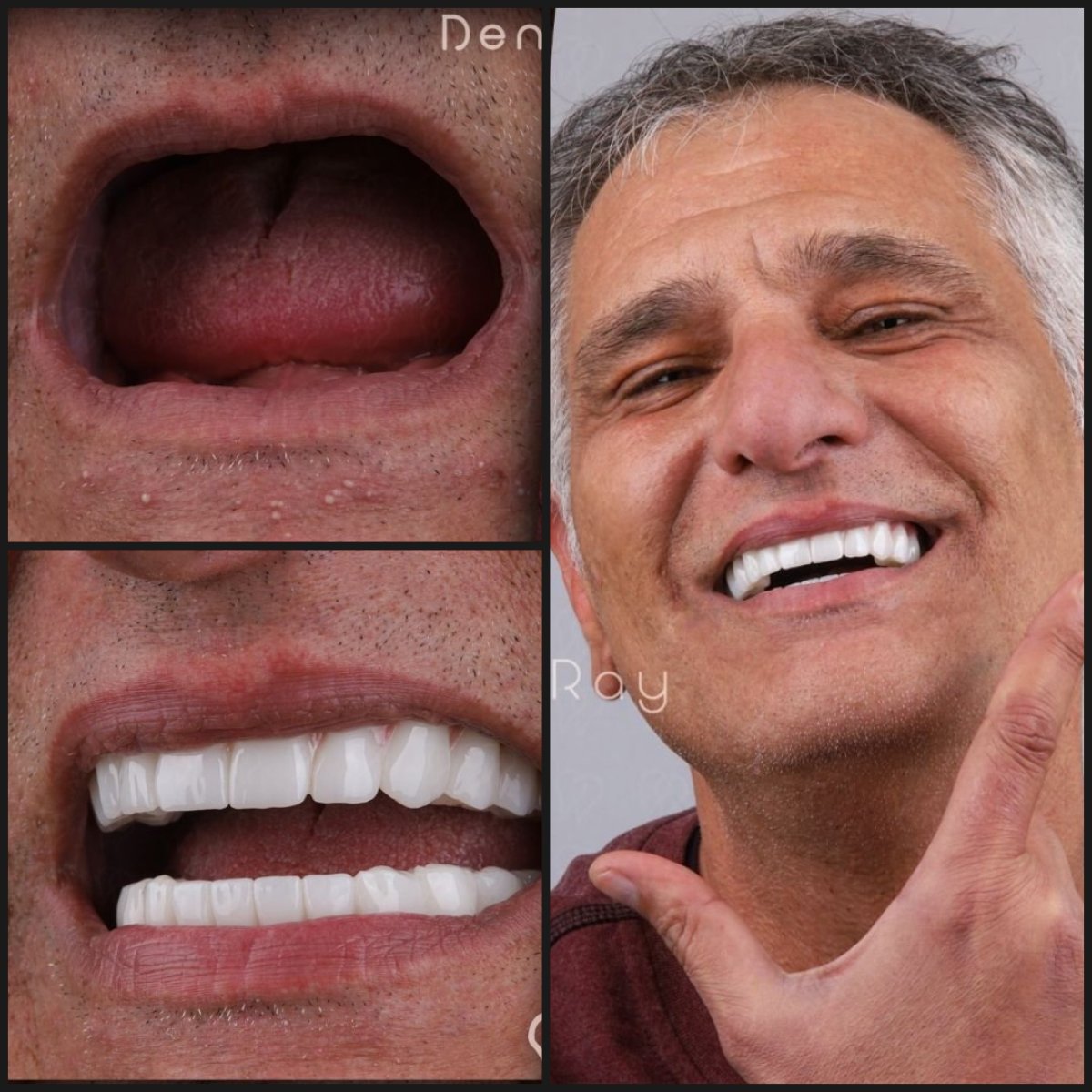 Resultado antes y después de implantes dentales All-on-6 en Dentaray Clinic, sonrisa restaurada