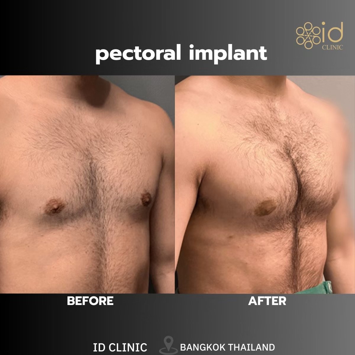 Before and after pectoral implant results at ID Clinic Bangkok, enhanced chest contour