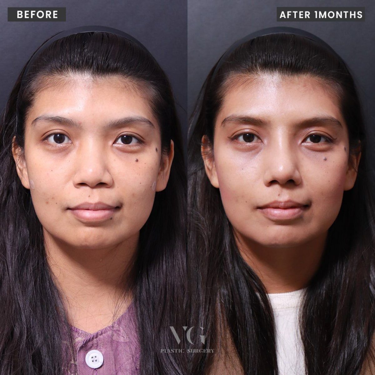 Resultados antes y después de rinoplastia étnica en VG Plastic Surgery, mejora de la nariz