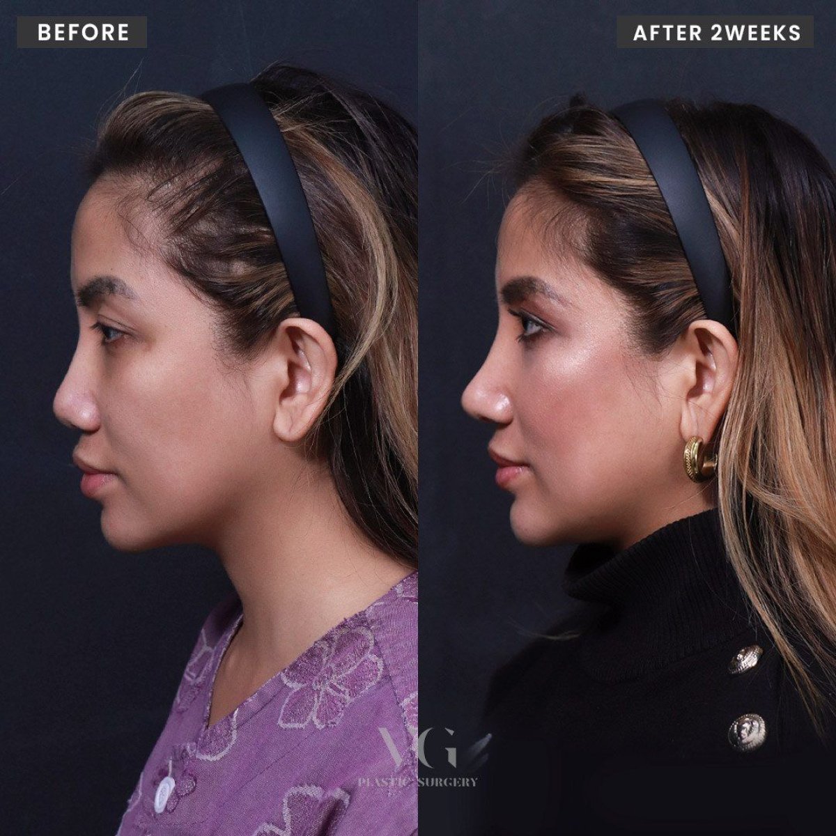 Результаты этнической ринопластики до и после в VG Plastic Surgery, коррекция носа за 2 недели