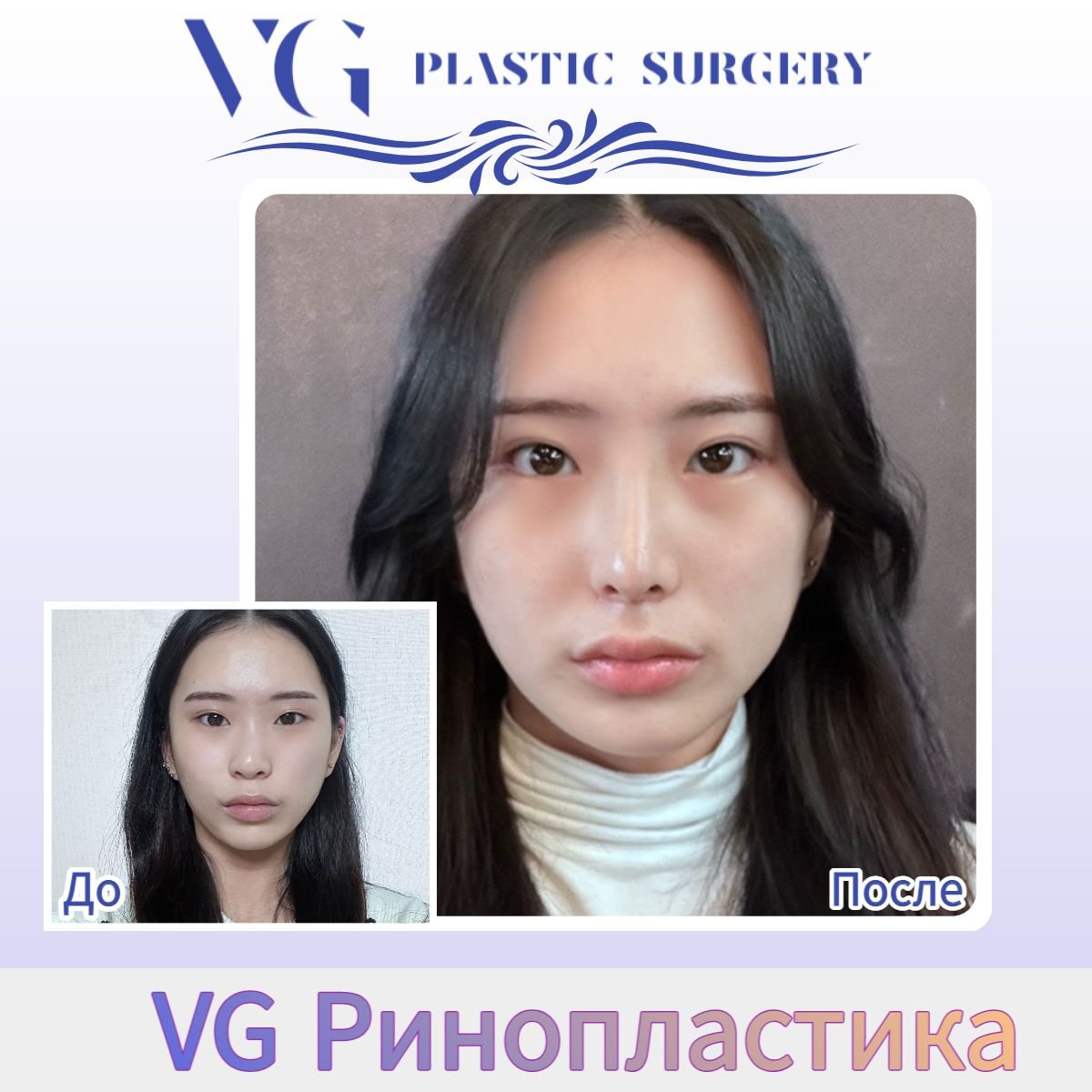نتيجة قبل وبعد تجميل طرف الأنف في VG Plastic Surgery، تحسين شكل الأنف