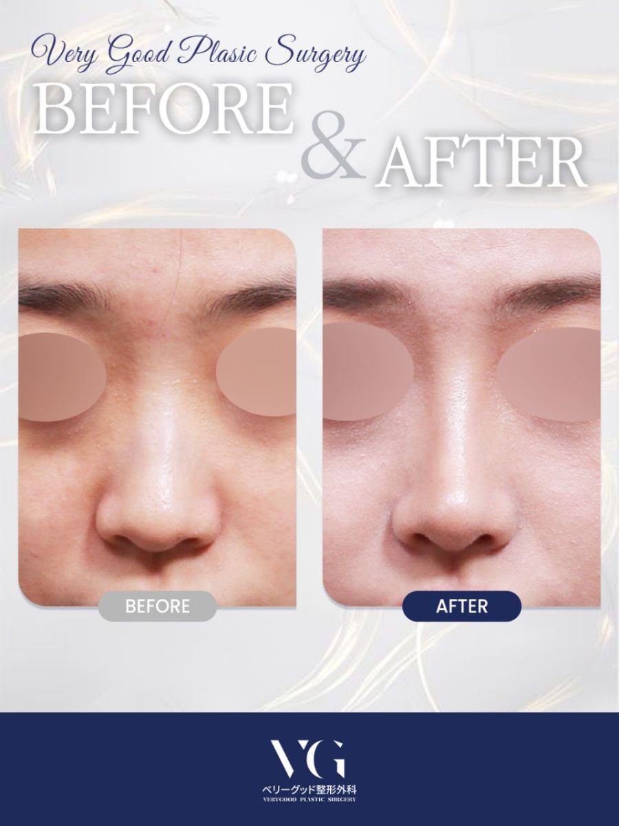 نتائج قبل وبعد تجميل طرف الأنف في VG Plastic Surgery، تحسين شكل الأنف