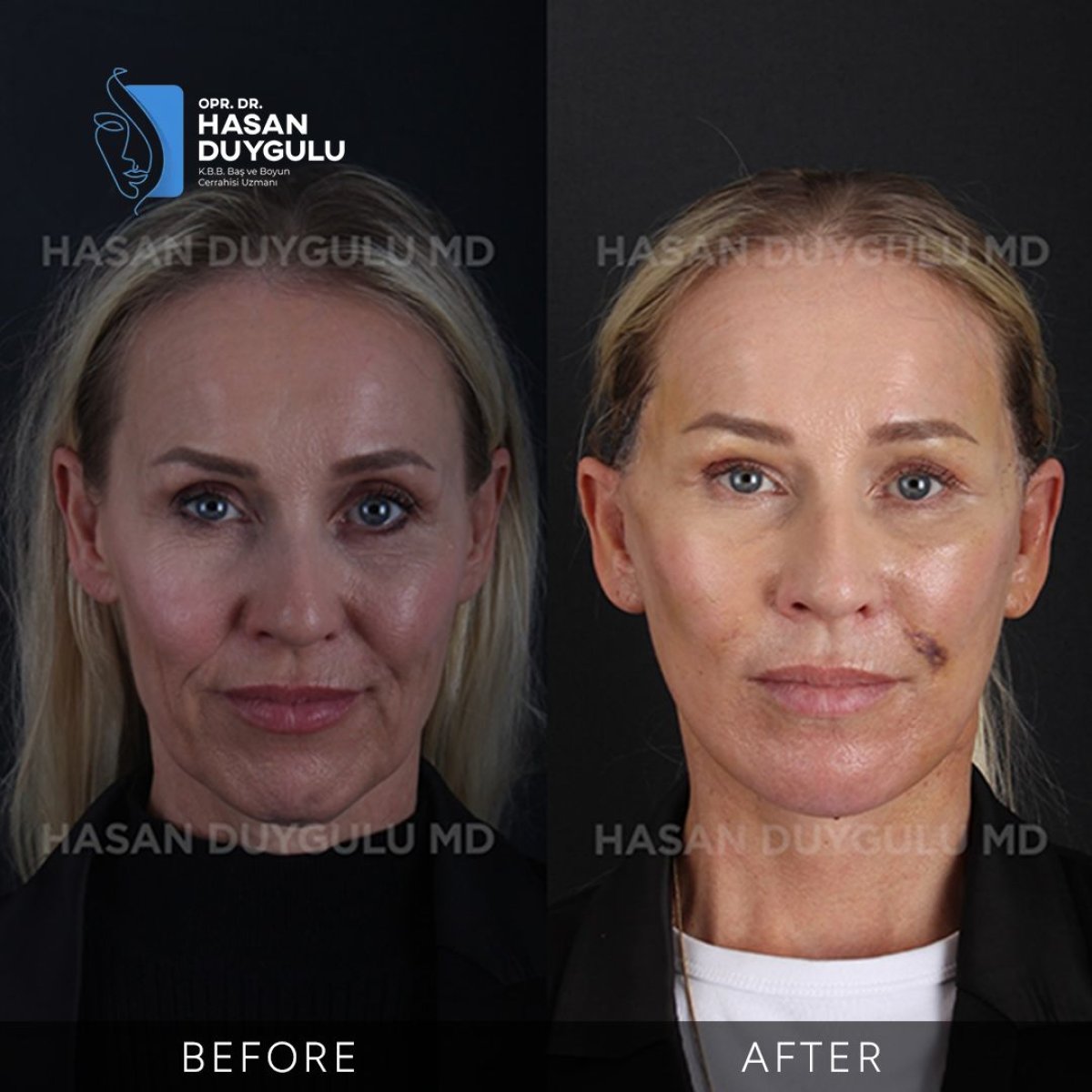 Resultados antes y después de deep plane facelift en Dr. Hasan Duygulu - Clínica Estética Turquía