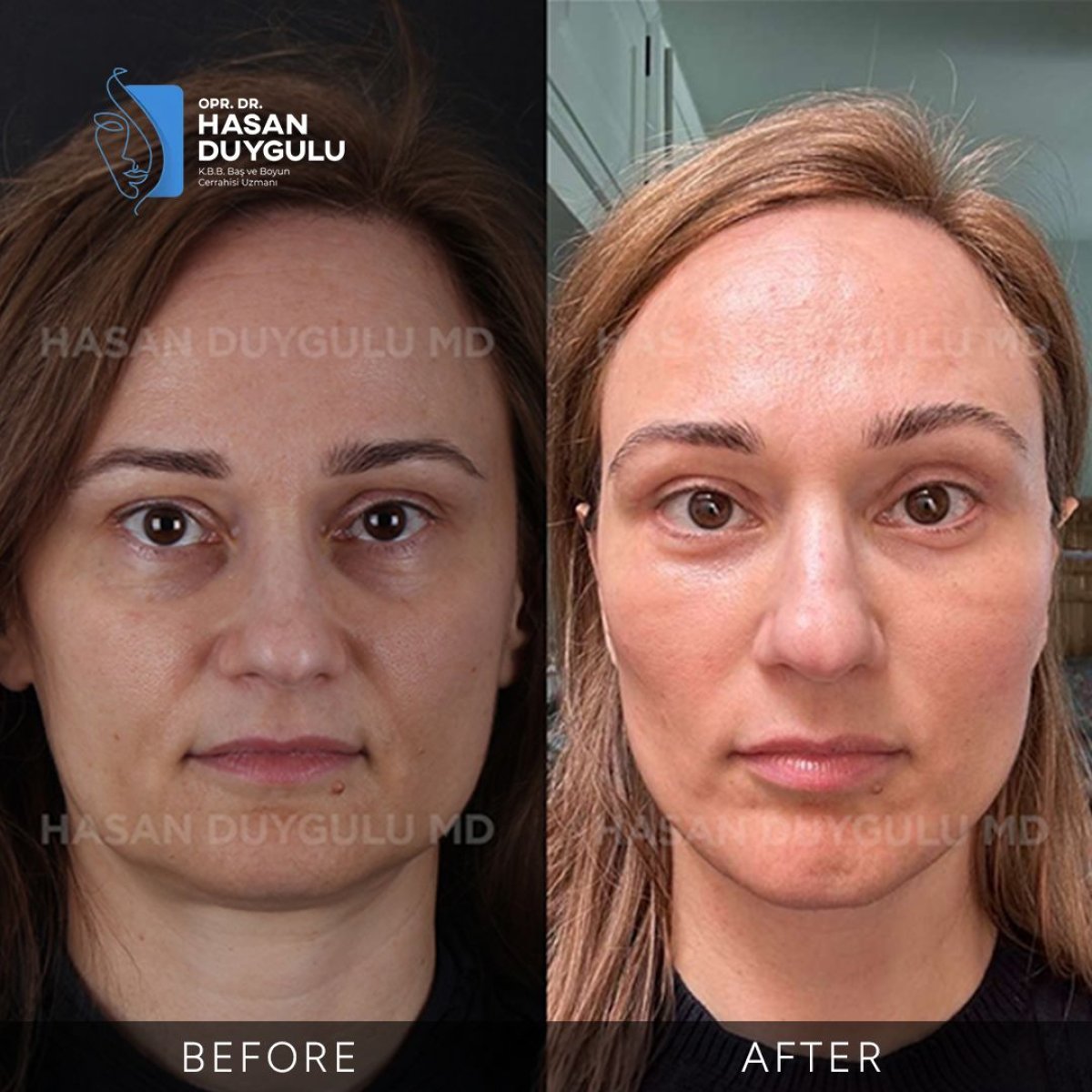 Resultados antes y después de deep plane facelift en Dr. Hasan Duygulu - Clínica Estética Turquía