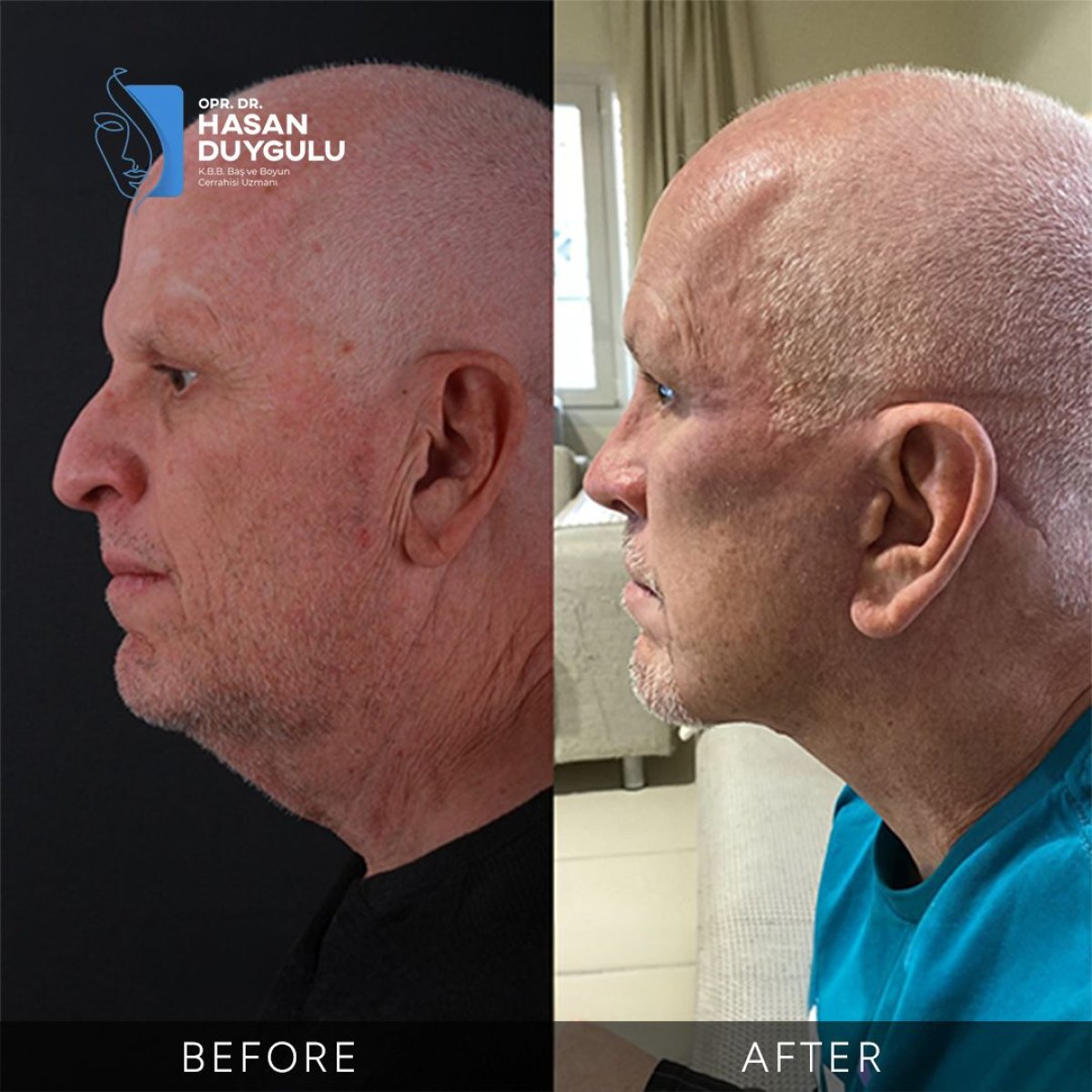 Resultado antes y después de deep plane facelift en Dr. Hasan Duygulu - Face Aesthetics Clinic Turkey