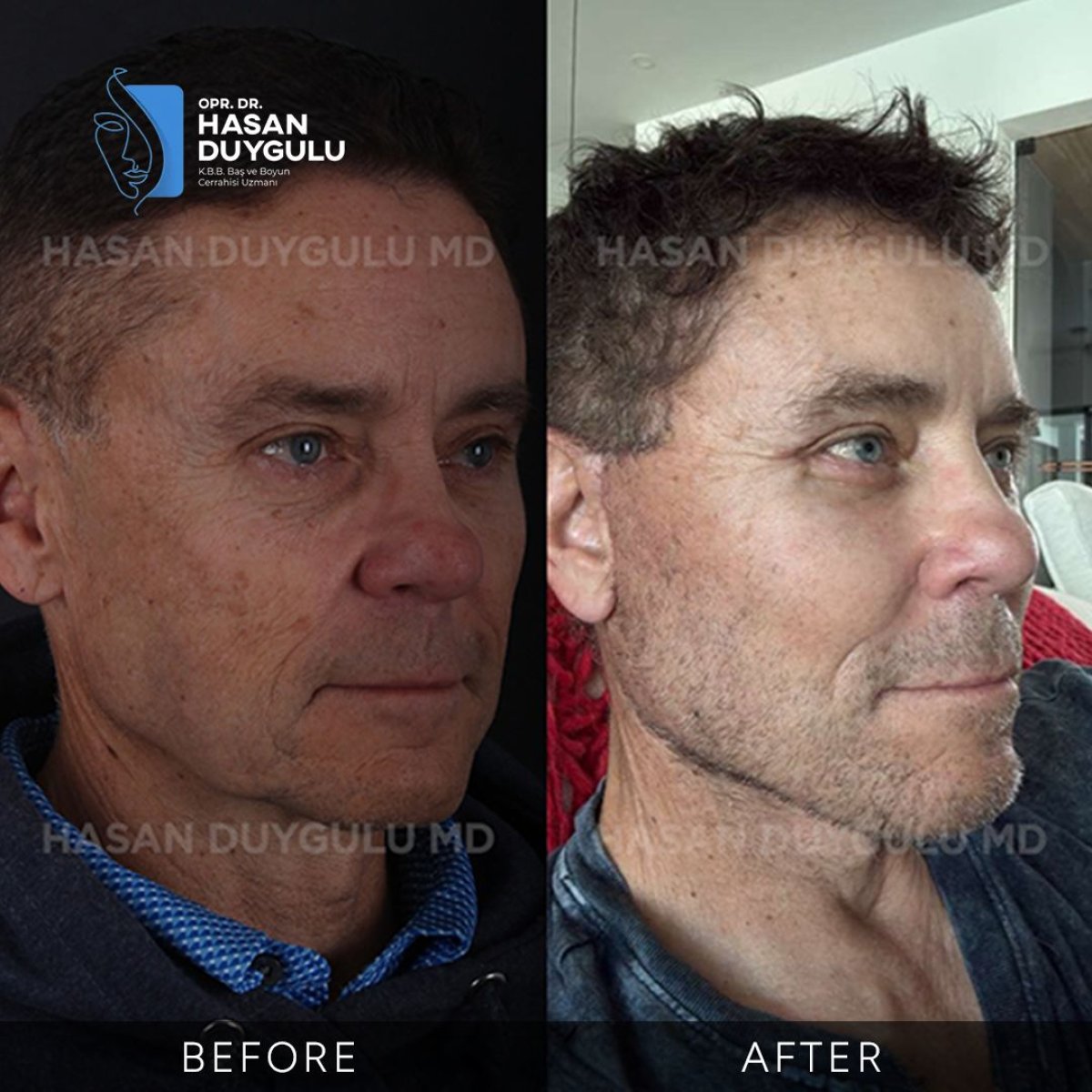 Resultados antes y después de deep plane facelift en Dr. Hasan Duygulu - Face Aesthetics Turquía