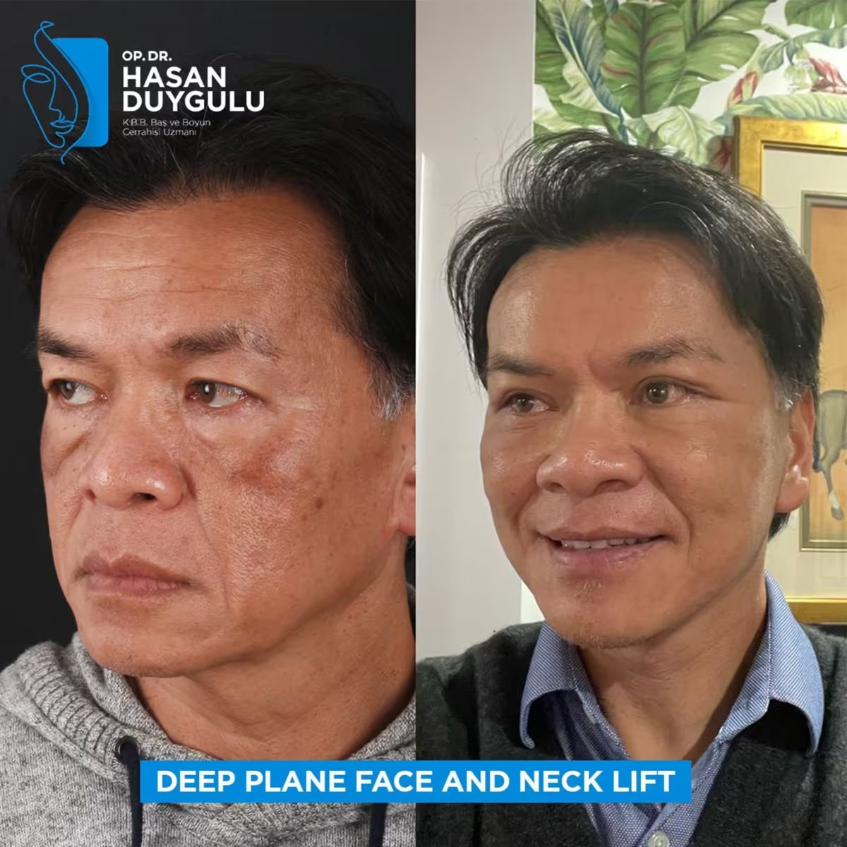 Resultados antes y después de lifting facial y de cuello deep plane en Dr. Hasan Duygulu Turquía