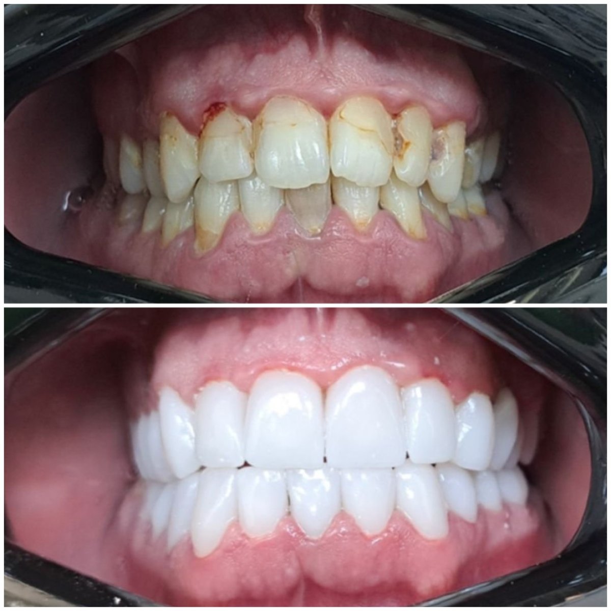 قبل وبعد تركيب تيجان الزركونيا في AllDental – نتائج استعادة الابتسامة