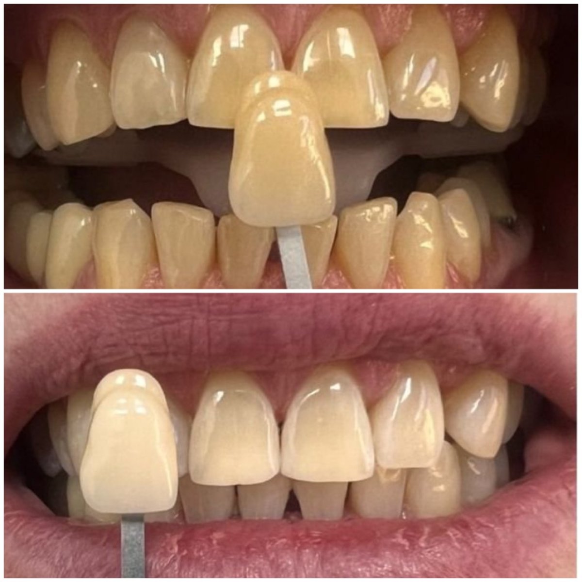 نتائج تبييض الأسنان قبل وبعد في AllDental – أسنان أكثر بياضاً ولمعاناً
