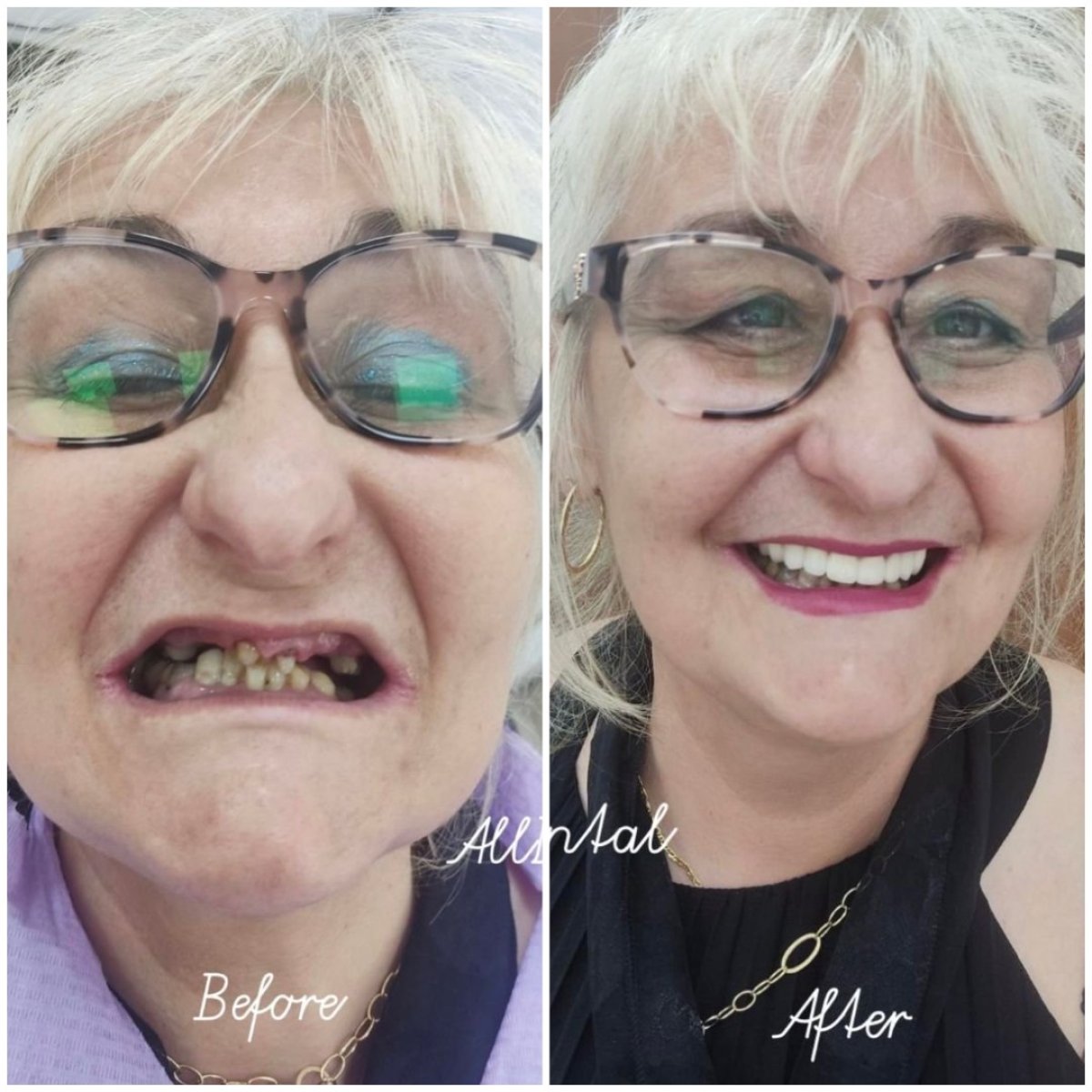 قبل وبعد تركيب تيجان الزركونيا في AllDental – نتائج تجميل الابتسامة