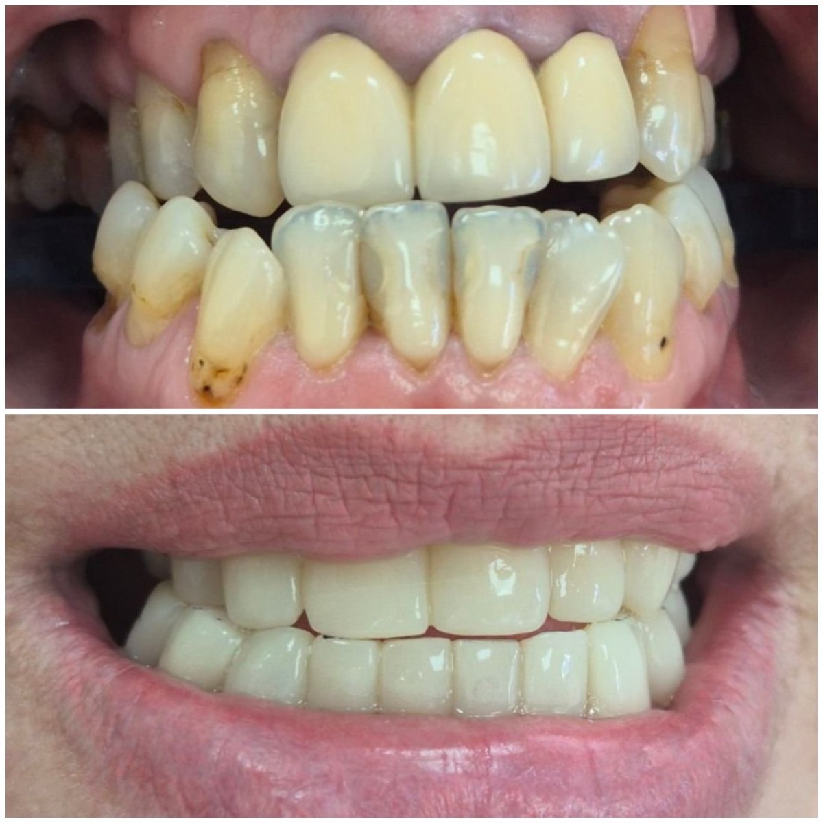 نتائج قبل وبعد تركيب تيجان الأسنان في AllDental – ابتسامة محسنة وأسنان أكثر بياضًا