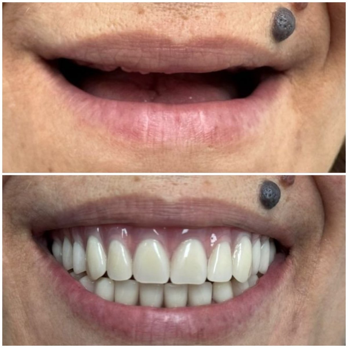 نتيجة قبل وبعد زراعة الأسنان All-on-4 في AllDental – استعادة الابتسامة الكاملة