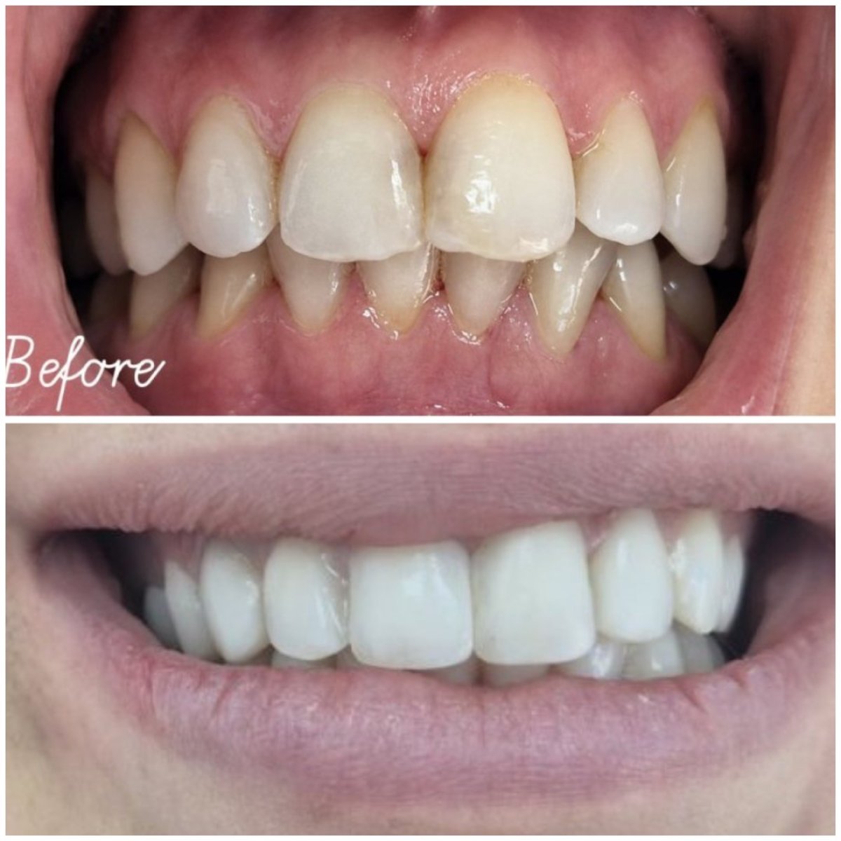 Résultats avant/après bonding dentaire chez AllDental – forme et sourire améliorés