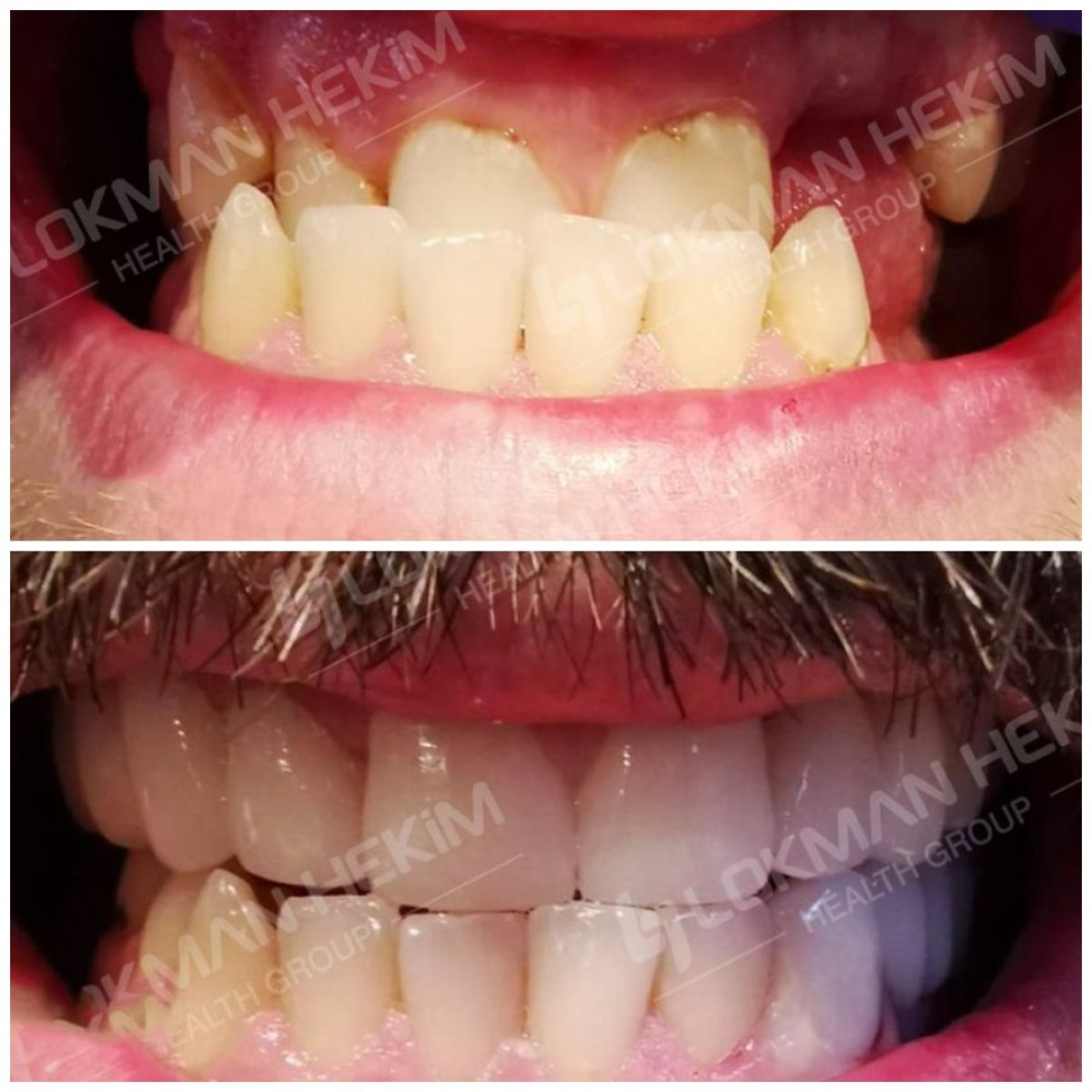 Antes y después de carillas dentales en Lokman Hekim Istanbul Hospital – mejora estética