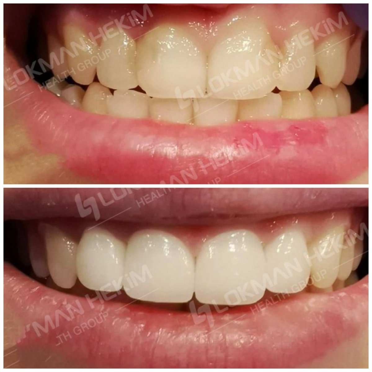 Antes y después de carillas dentales en Lokman Hekim Istanbul Hospital, sonrisa natural