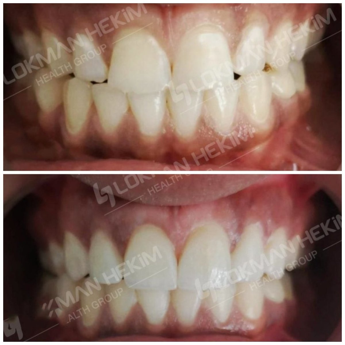Antes y después de carillas dentales en Lokman Hekim Istanbul Hospital – mejora estética de la sonrisa