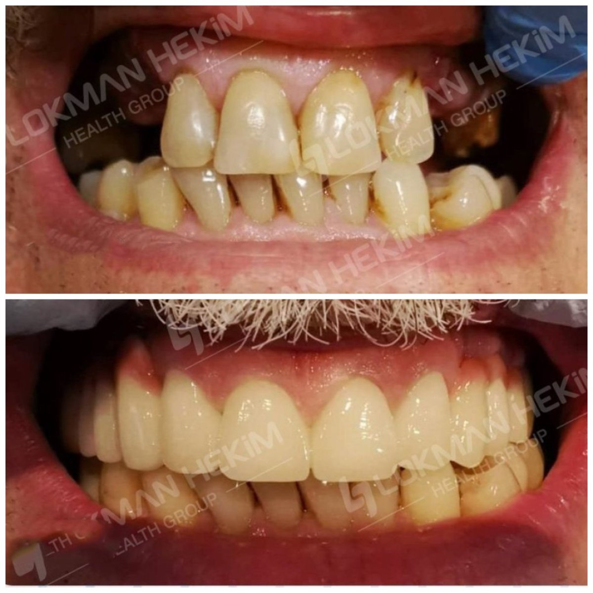 Antes y después de carillas dentales en Lokman Hekim Istanbul Hospital – sonrisa mejorada y dientes más blancos