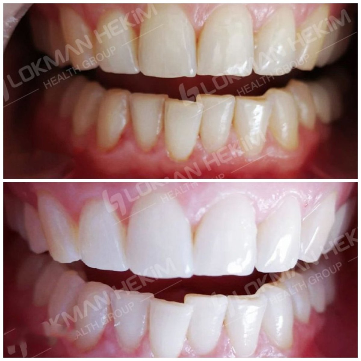 Antes y después de carillas dentales en Lokman Hekim Istanbul Hospital – mejora estética