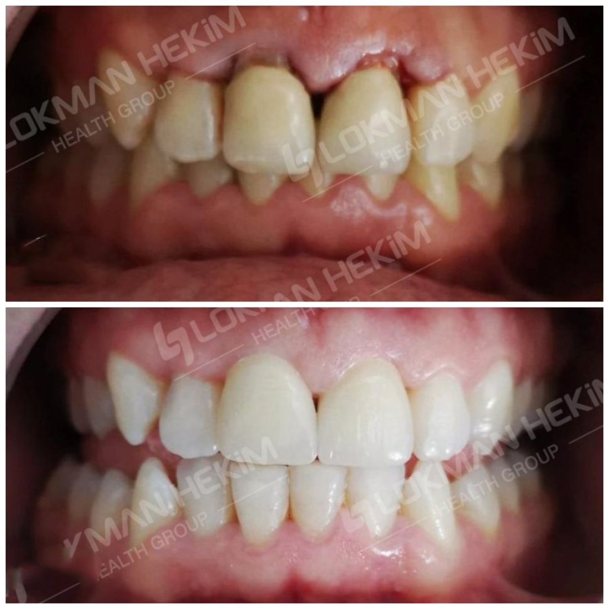Antes y después de carillas dentales en Lokman Hekim Istanbul Hospital – resultados de sonrisa