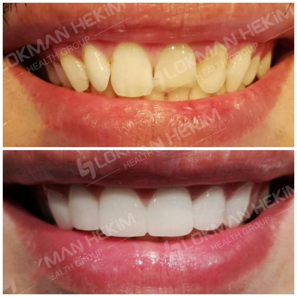 Antes y después de carillas dentales en Lokman Hekim Istanbul Hospital – sonrisa natural