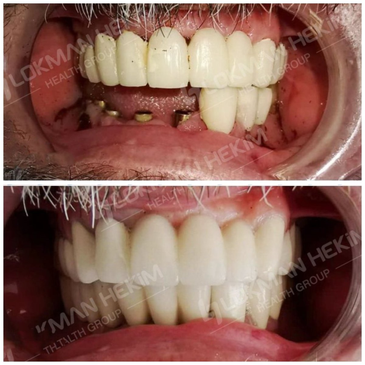 Antes y después de carillas dentales en Lokman Hekim Istanbul Hospital, sonrisa mejorada