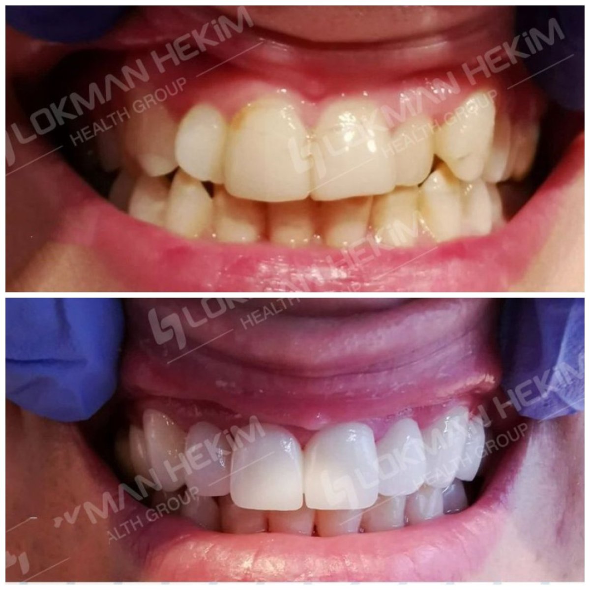 Antes y después de carillas dentales en Lokman Hekim Istanbul Hospital, resultado de sonrisa