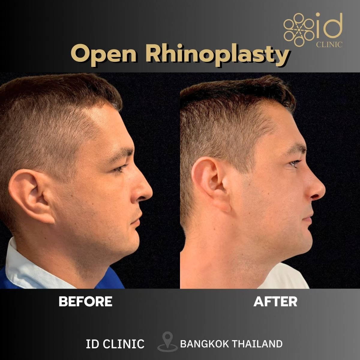 نتائج قبل وبعد عملية تجميل الأنف المفتوحة في ID Clinic Bangkok وتحسين شكل الأنف