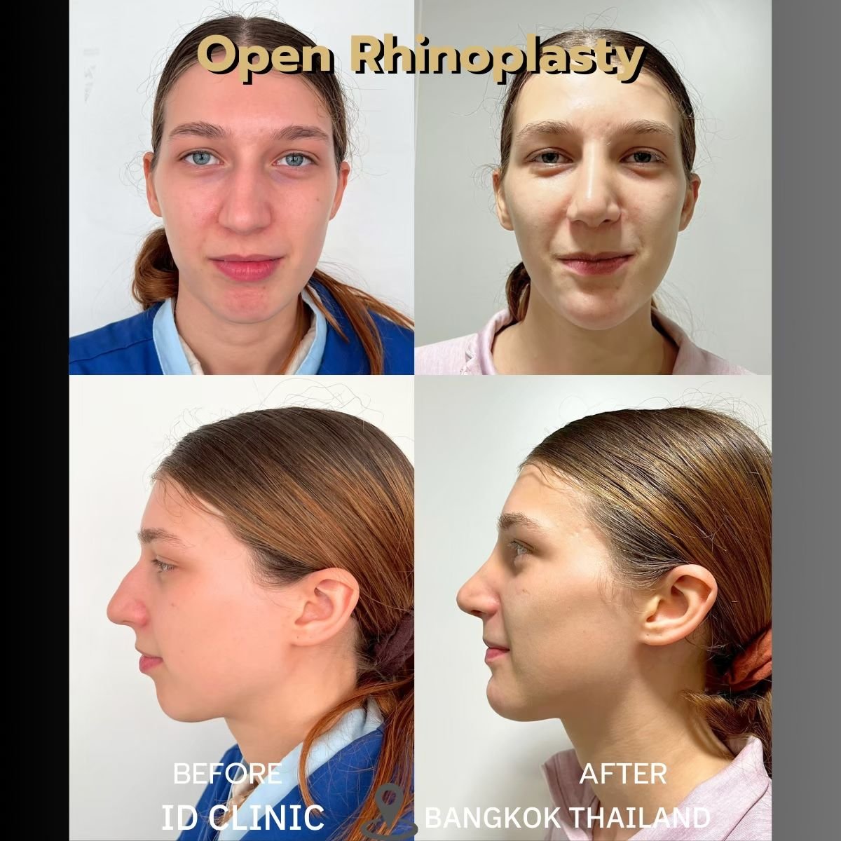 نتائج قبل وبعد عملية تجميل الأنف المفتوحة في ID Clinic Bangkok، تحسين شكل الأنف
