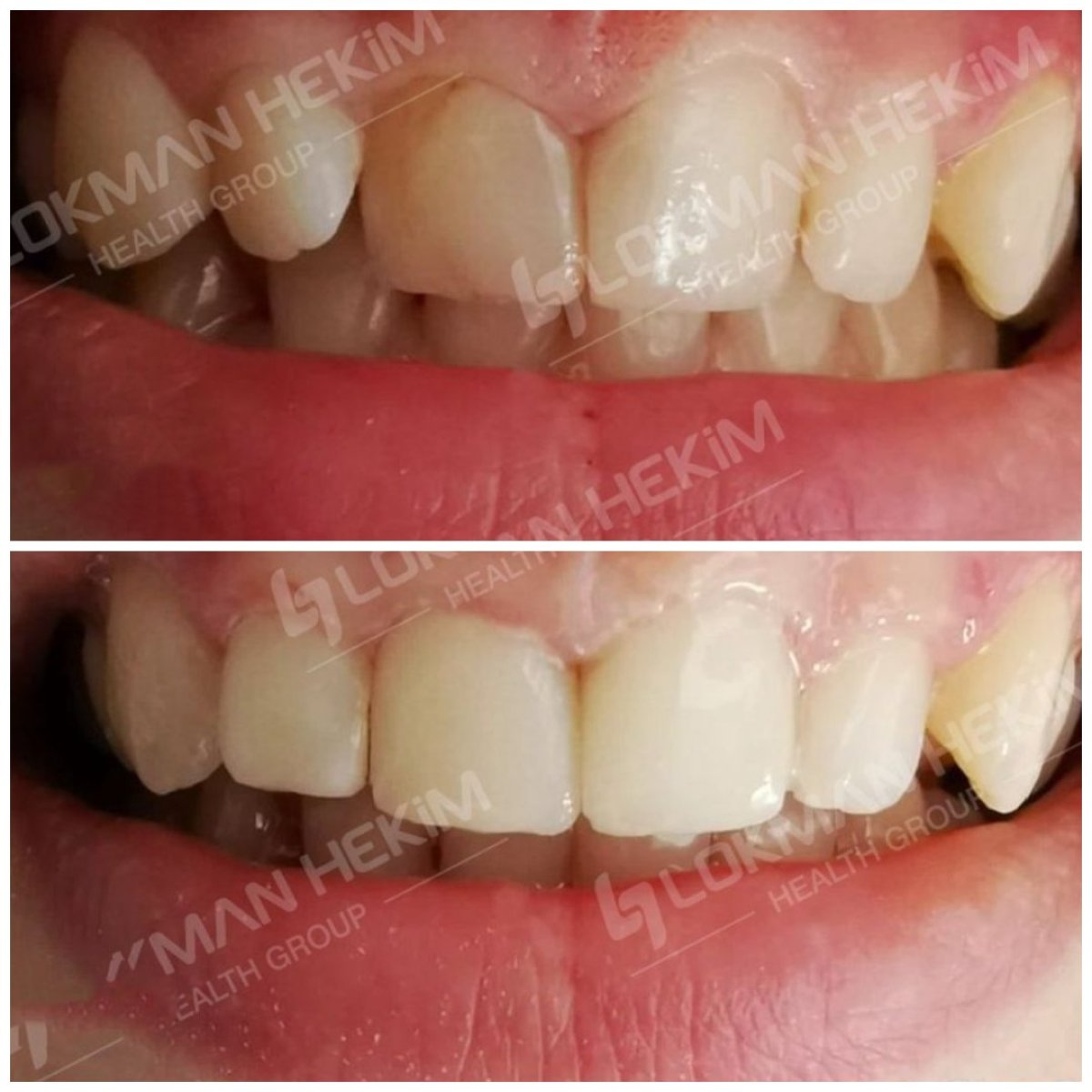 Antes y después de carillas dentales en Lokman Hekim Istanbul Hospital – mejora estética