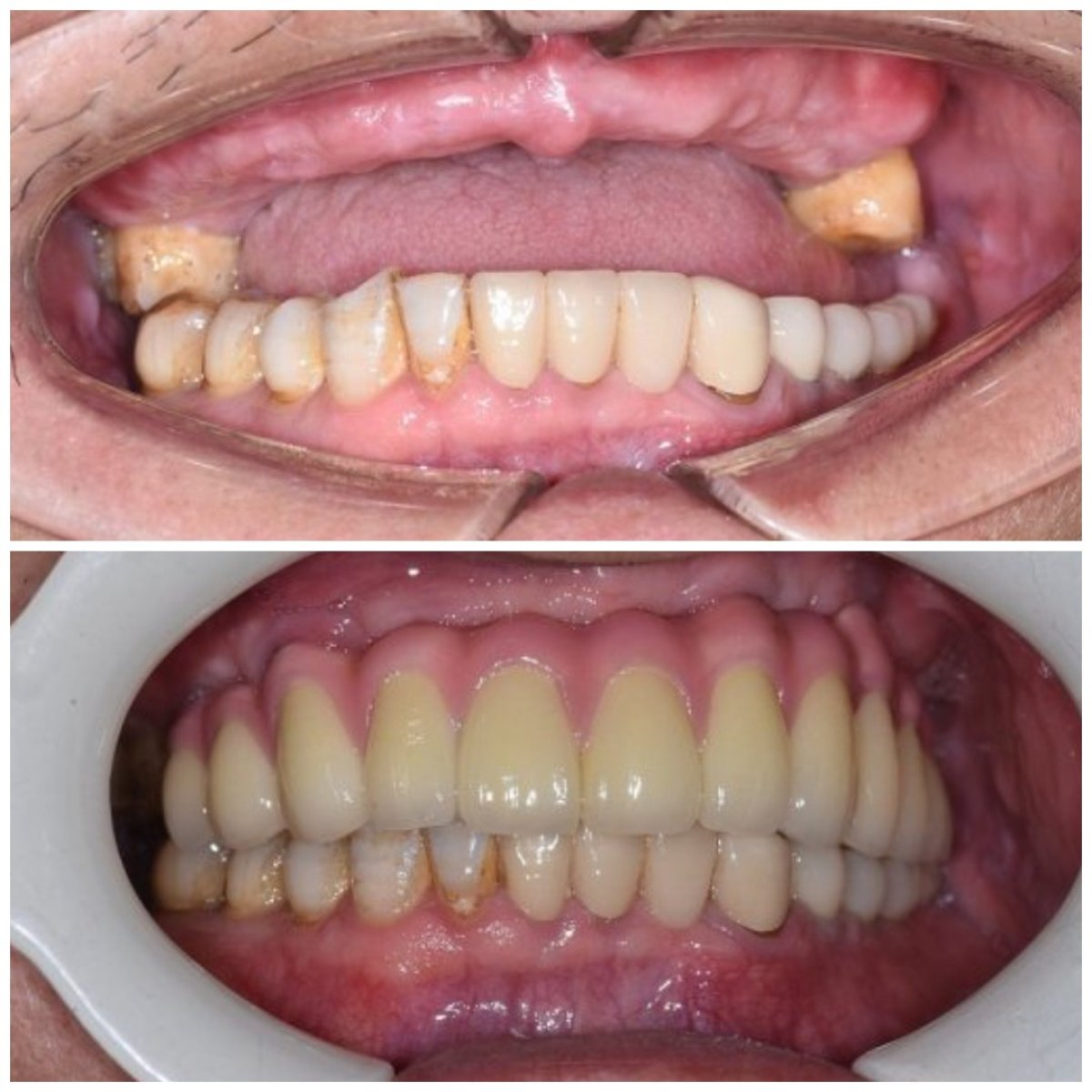 Результати до і після імплантації зубів у Qinghua Sunshine Dentistry (Wuhan), відновлена посмішка