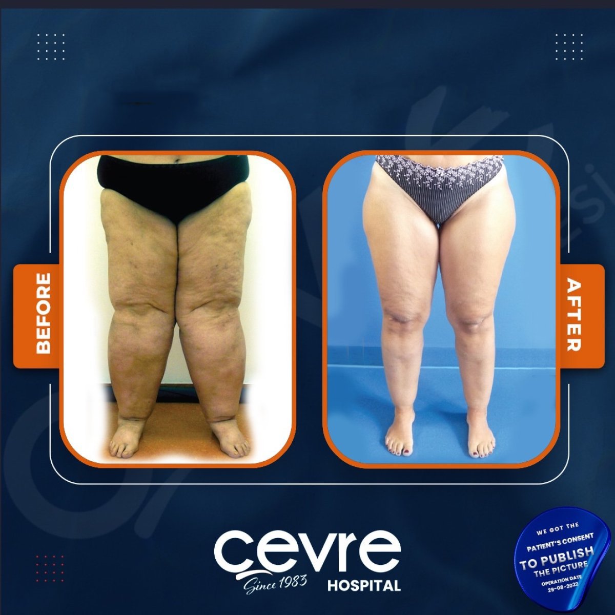 نتائج شد الفخذين قبل وبعد في مركز Adem and Havva Medical Center، تحسين شكل الساقين