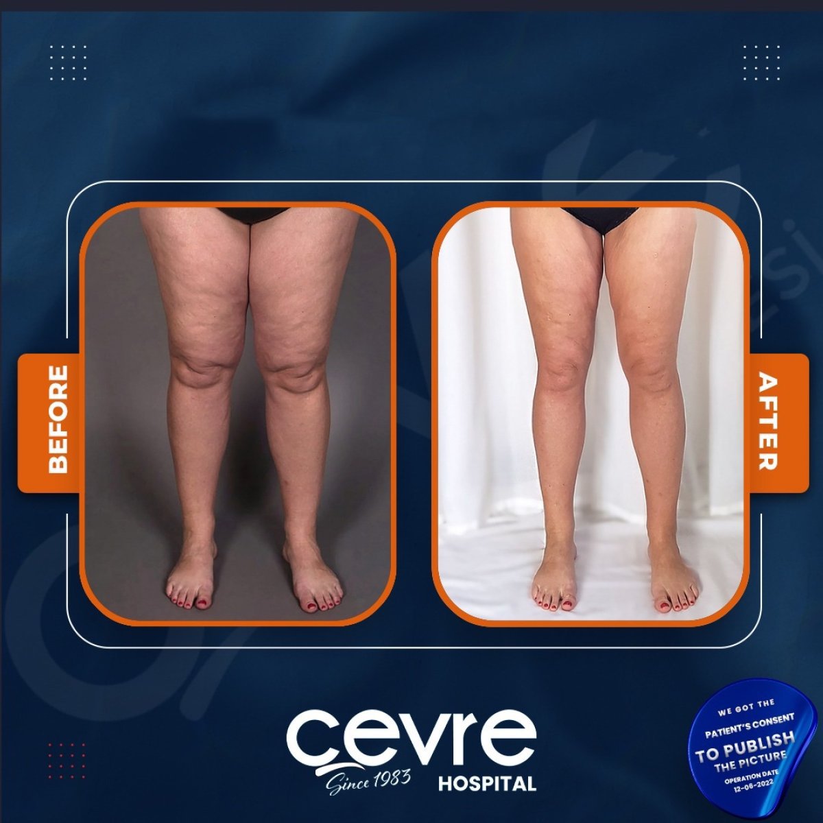 نتائج شد الفخذين قبل وبعد في Adem and Havva Medical Center، مظهر أفخاذ أنحف